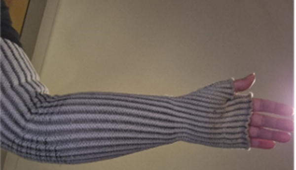 A lymphoedema sleeve that was unable to be properly diagnosed via telehealth.